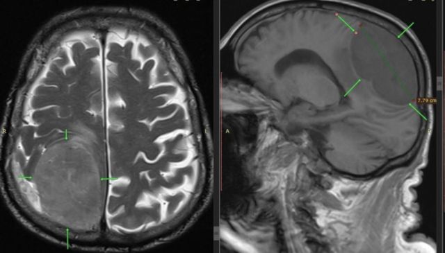 В Пятигорске мужчине удалили опухоль мозга размером с лимон
