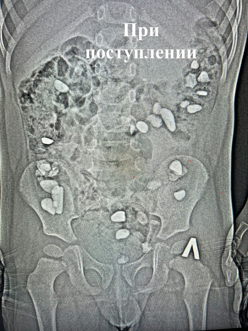 В Ессентуках врачи извлекли 25 камней из организма трёхлетнего мальчика