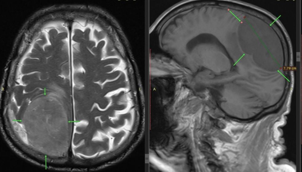 В Пятигорске мужчине удалили опухоль мозга размером с лимон