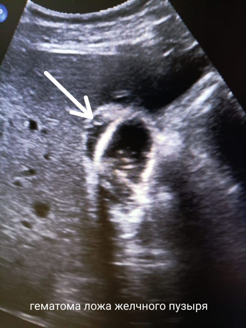 Ставропольские медики спасли пациента с отрывом желчного пузыря без операции