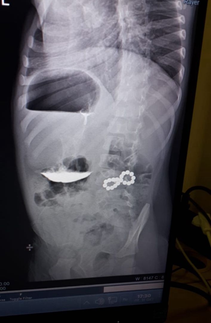 Ставропольские хирурги спасли трехлетнего мальчика, проглотившего 18 магнитов