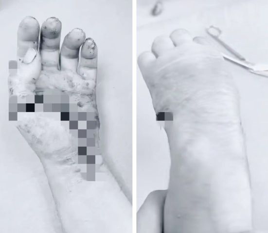 В Пятигорске врачи пришили пациенту отпиленную кисть