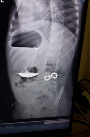 Ставропольские хирурги спасли трехлетнего мальчика, проглотившего 18 магнитов