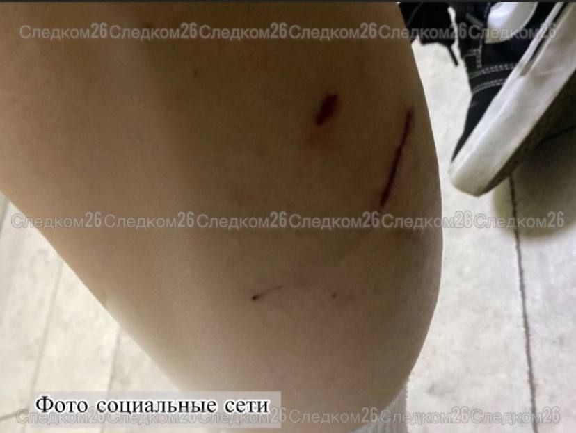 СКР возбудил дело о халатности после нападения собак на девушку в Минводах