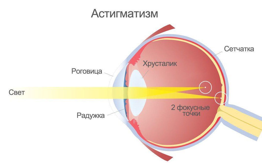 Клиника заботы о зрении «Три-З» дарит скидку на коррекцию астигматизма