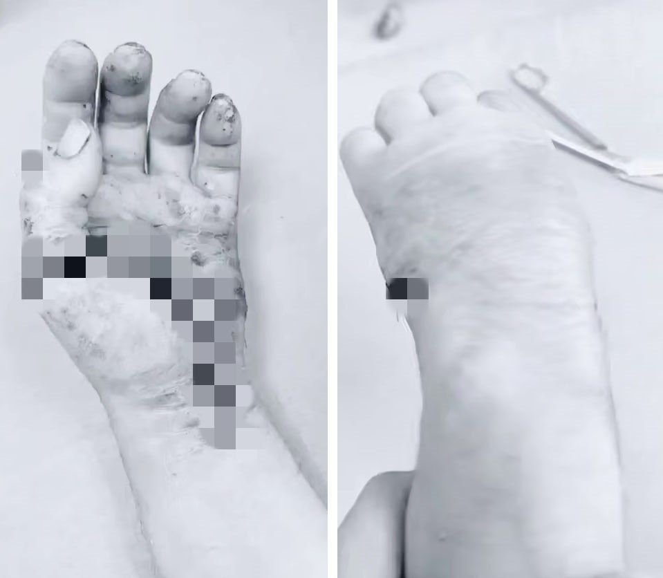 В Пятигорске врачи пришили пациенту отпиленную кисть