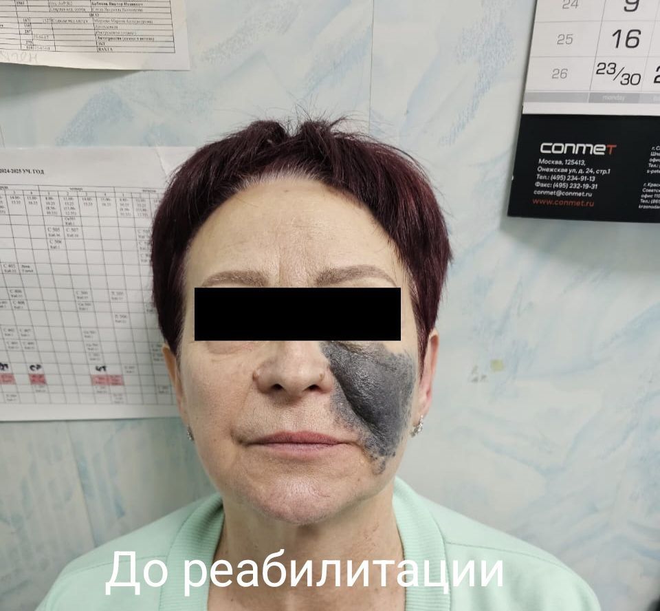 Ставропольские хирурги удалили с лица пациентки гигантскую врождённую родинку