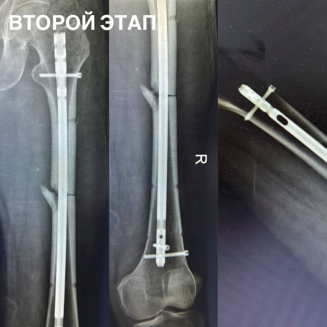 Ставропольские врачи спасли мужчину после падения с 7-метровой высоты